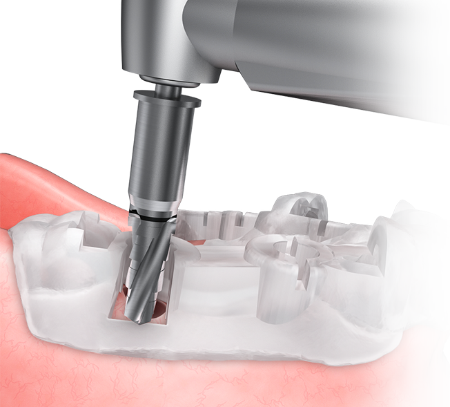 Guide Surgery Osstem Implant