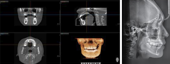 바텍 3D CT 촬영 장비